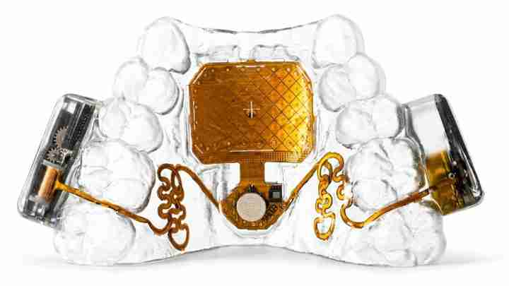 Clear dental model showing a gold-plated implant in the center with surrounding wiring for a dental prosthetic